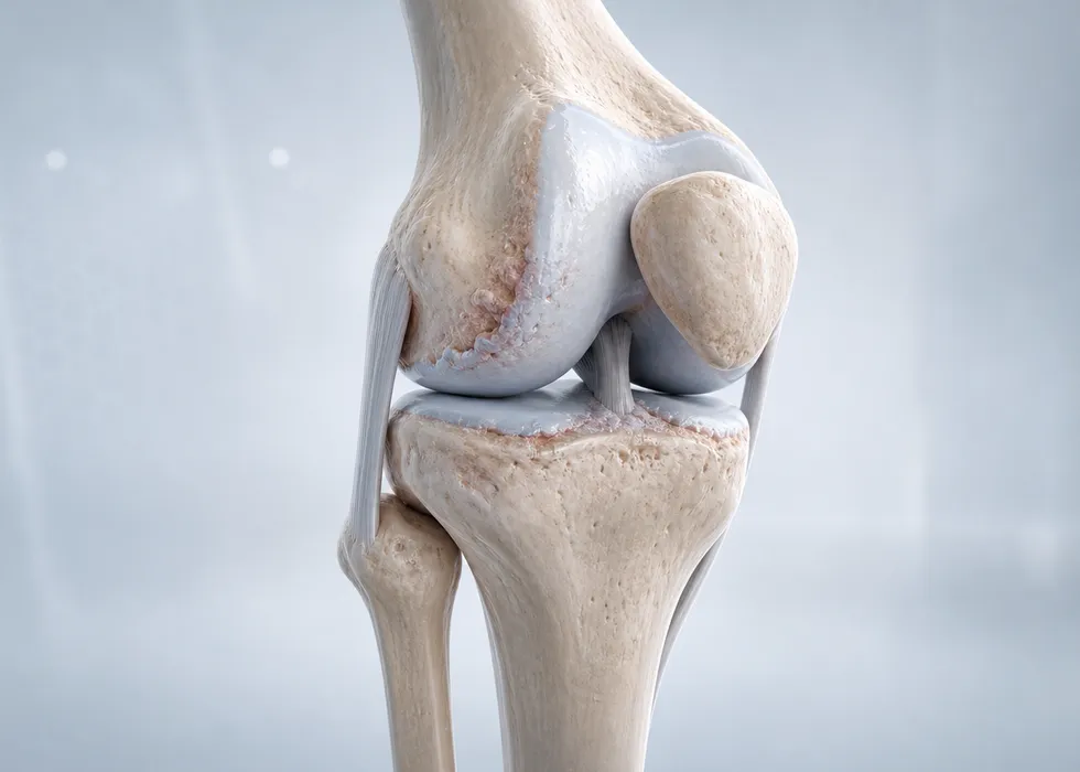 Knee Osteoarthritis